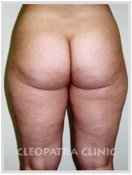 liposuction of the hips, outer, inner thighs and knees