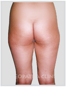 Fettabsaugung der Hüften, äußeren, inneren Oberschenkel und Knie