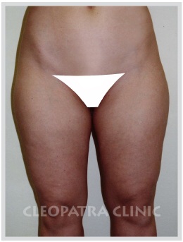 Liposukcja - biodra - talia i nerki, uda - zewnętrzne i wewnętrzne, kolana - wewnątrz