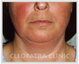 Chin liposuction - fat extraction