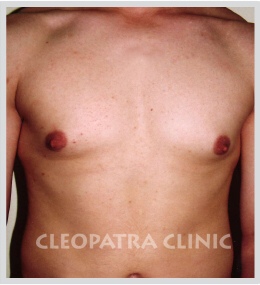 reduction of male breasts