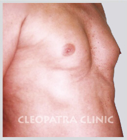 Gynecomastia - reduction - liposuction + surgical removal of the glands