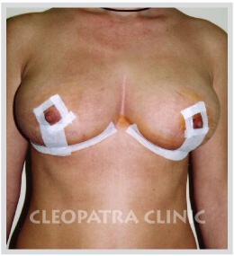 Das Anheben der herabgelassenen Brüste muss die Größe des Brustimplantats ausfüllen