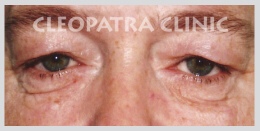 upper and lower eyelid surgery
