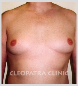 Gynecomastia - reduction - liposuction + surgical removal of the glands