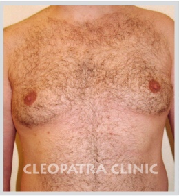 reduction of male breasts by liposuction and removal of enlarged mammary gland - 3 months after the procedure