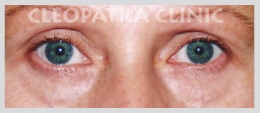 Operation der unteren Augenlider