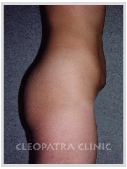 Fettabsaugung der äußeren Oberschenkel und des Bauches