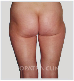 liposukcja zewnętrznych i wewnętrznych ud