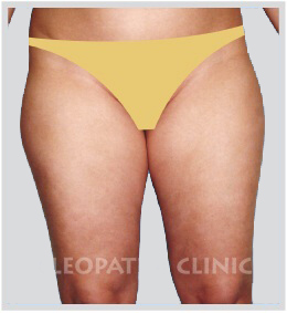 Liposuction of thigh - external and internal