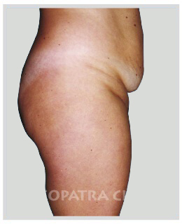 Odstranění přebytku kůže a tuku bikinovým řezem se suturou svalů, s posunem pupku
