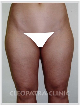 Liposuction - hips - waist and kidneys, thighs - external and internal, knees - inside