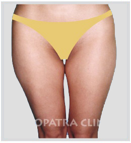 Liposuction of external and internal thighs
